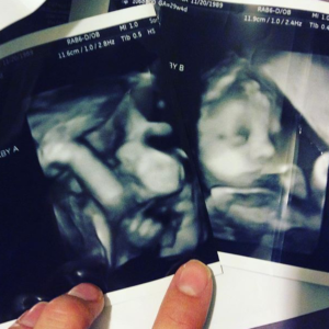 twin ultrasound photo fraternal twin birth story